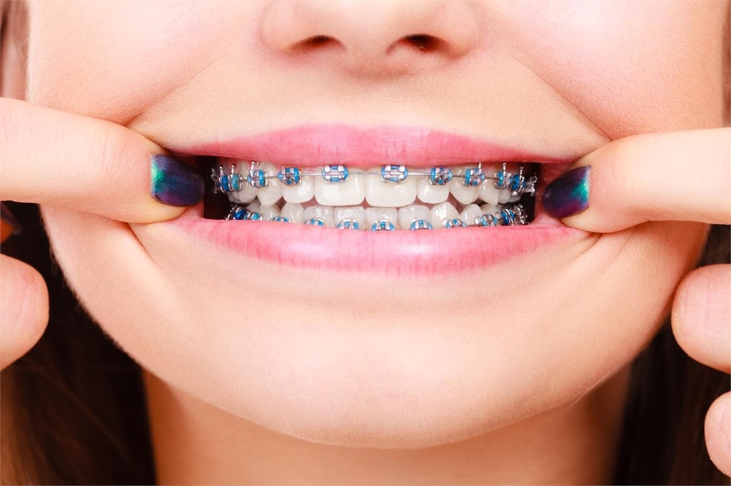 ¿Cómo limpiar correctamente los brackets? Consejos prácticos para pacientes con ortodoncia