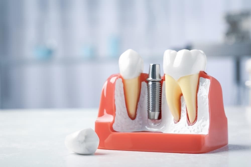 Descubre las ventajas de las prótesis dentales fijas y removibles