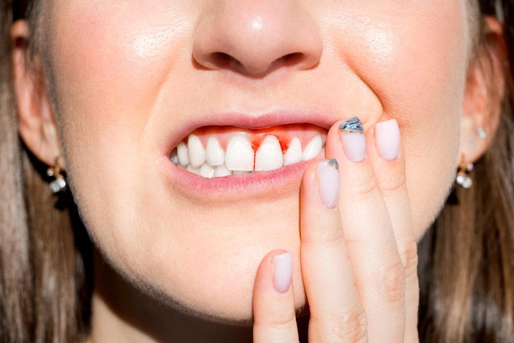¿Es normal sangrar al cepillarse los dientes?